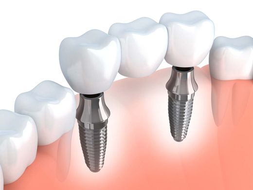 Implantat mit Brücke